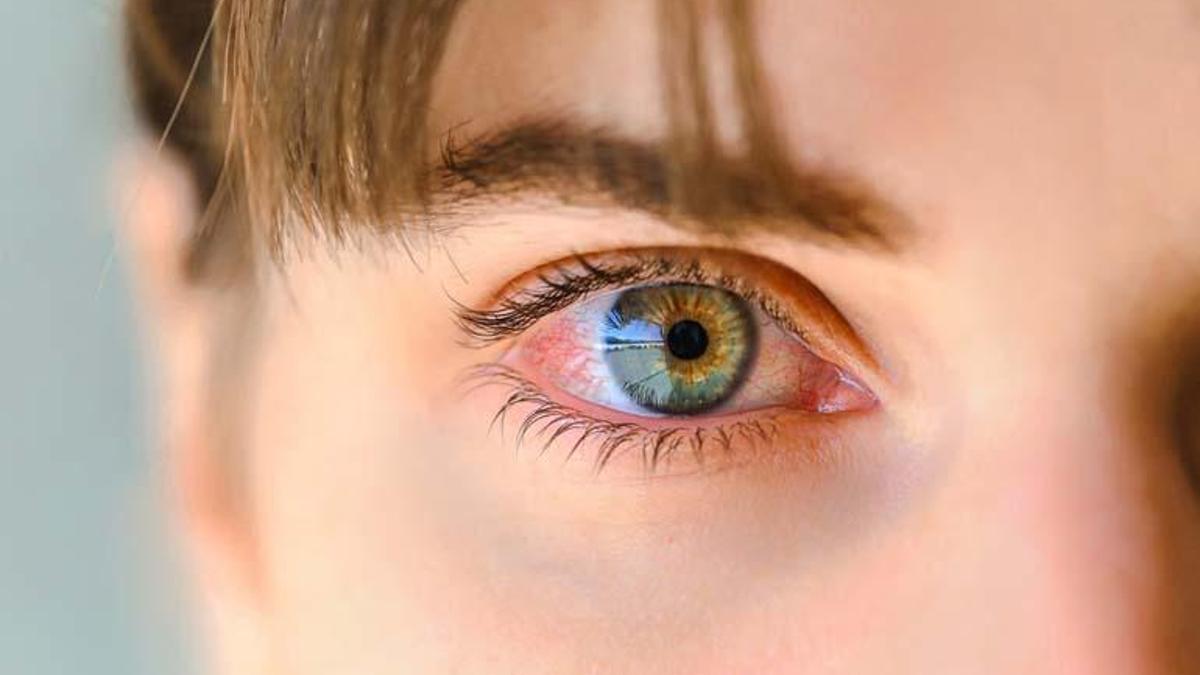 BLEFARİT (Kirpik dibi iltihabı) Nedir?